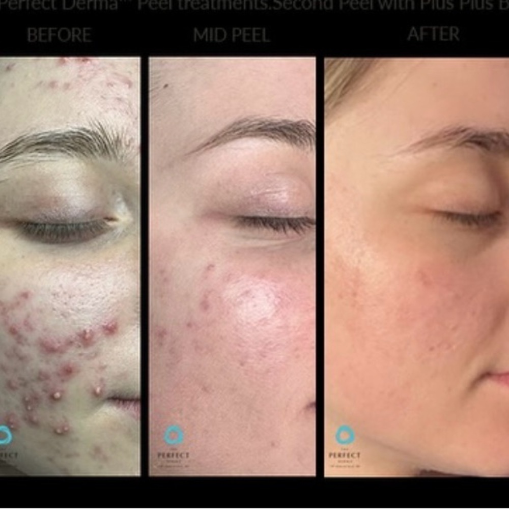 THE PERFECT DERMA™ PEEL